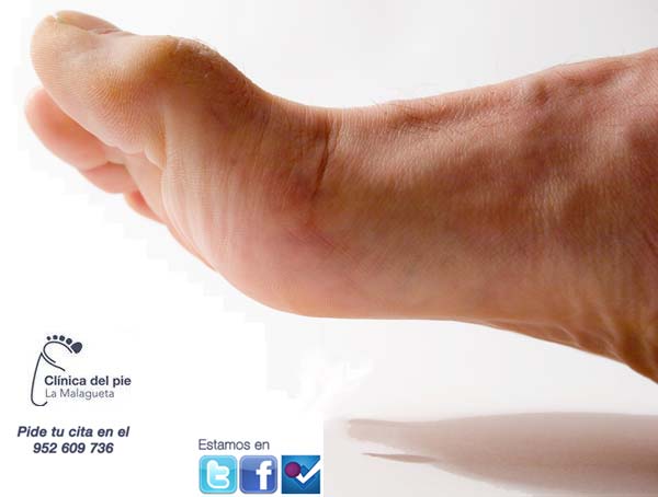 clinica_del_pie_la_malagueta_micosis