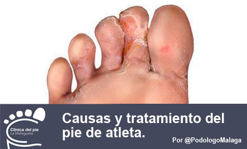 Causas y tratamiento pie de atleta por podologo malaga