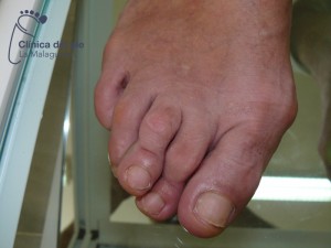 podólogo málaga: cirugía juanetes podólogo málaga: cirugía juanetes