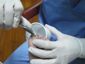 onicomicosis - hongos en las uñas de los pies - podologo malaga