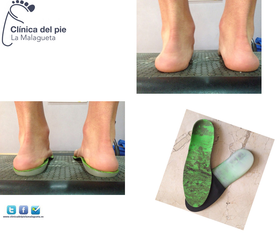plantillas_3d_malaga_clinica_del_pie_la_malagueta